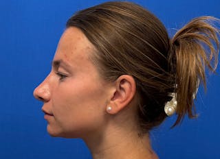 Rhinoplasty Before & After Gallery - Patient 244094 - Image 2