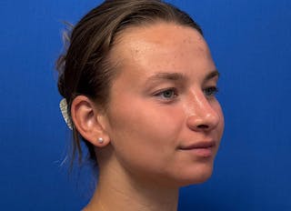 Rhinoplasty Before & After Gallery - Patient 244094 - Image 8
