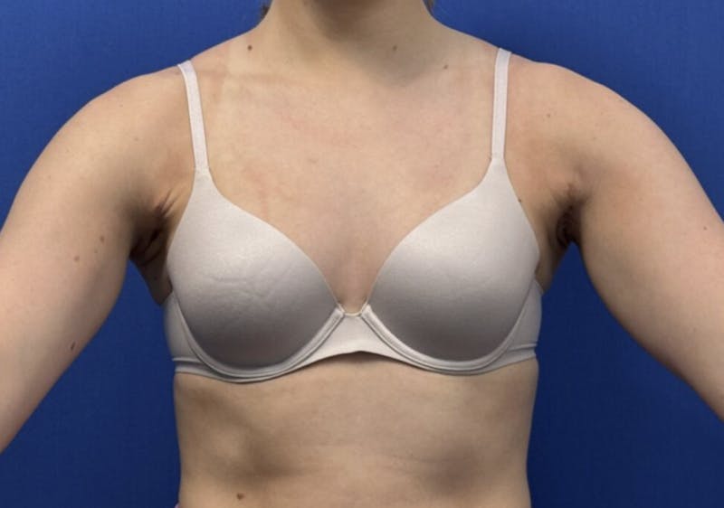Axillary Breast Removal Before & After Gallery - Patient 457797 - Image 2