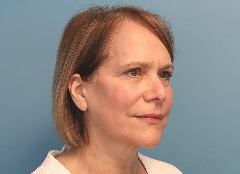 Facelift Before & After Gallery - Patient 121727146 - Image 8