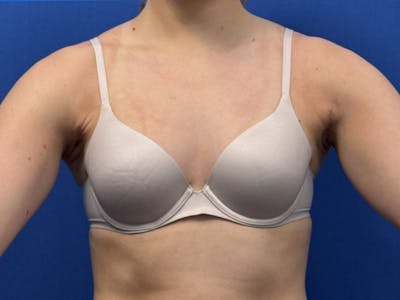 Axillary Breast Removal Before & After Gallery - Patient 457797 - Image 2