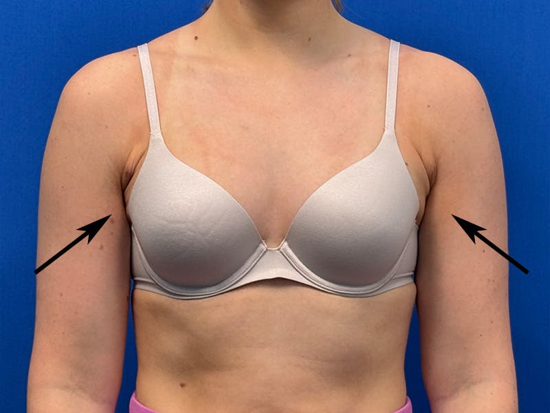 Axillary Breast Removal Before & After Gallery - Patient 457797 - Image 4