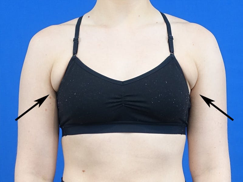 Axillary Breast Removal Before & After Gallery - Patient 457797 - Image 3