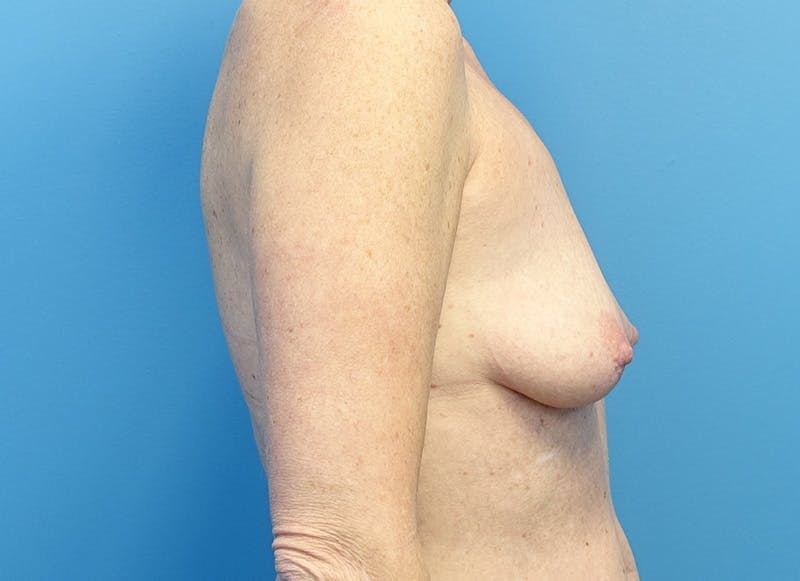 Hybrid Reconstruction Gallery Before & After Gallery - Patient 219289 - Image 9