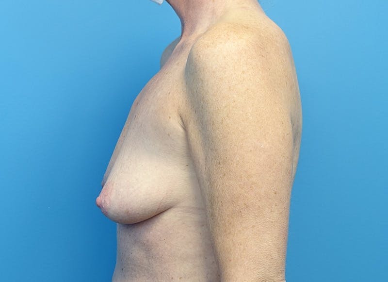 Hybrid Reconstruction Gallery Before & After Gallery - Patient 219289 - Image 1