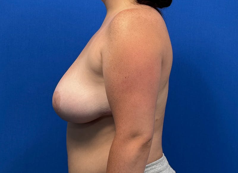Breast Reduction Before & After Gallery - Patient 345901 - Image 2