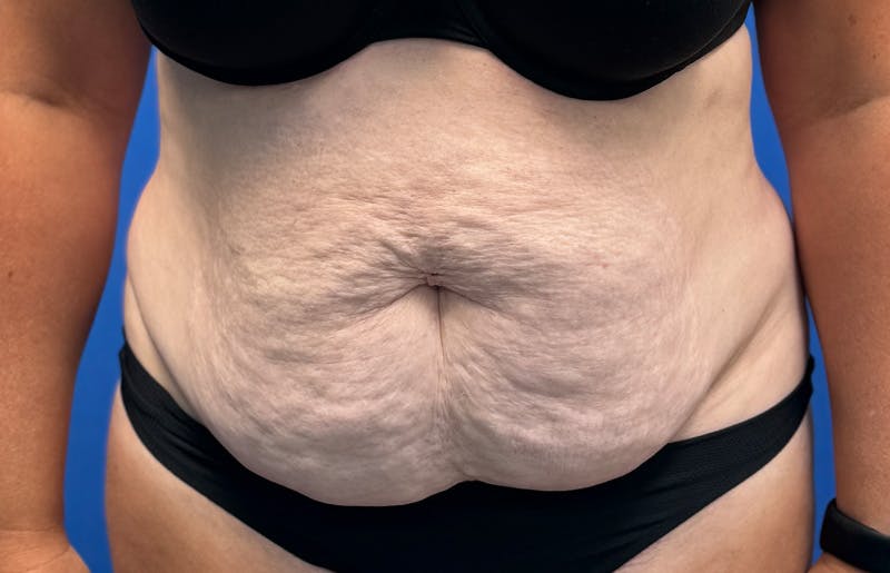 Abdominoplasty Before & After Gallery - Patient 352301 - Image 5