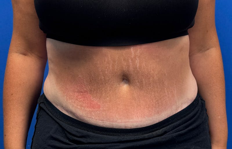 Abdominoplasty Before & After Gallery - Patient 352301 - Image 6