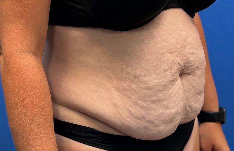 Abdominoplasty Before & After Gallery - Patient 352301 - Image 7