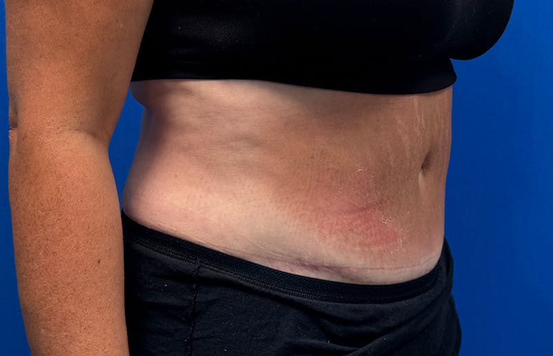 Abdominoplasty Before & After Gallery - Patient 352301 - Image 8