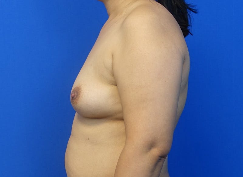 Flap Reconstruction Gallery Before & After Gallery - Patient 319108 - Image 1