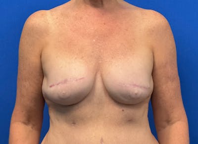 Flap Reconstruction Gallery Before & After Gallery - Patient 410362 - Image 6