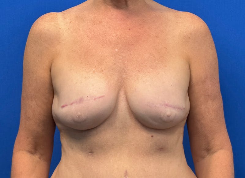 Flap Reconstruction Gallery Before & After Gallery - Patient 410362 - Image 6