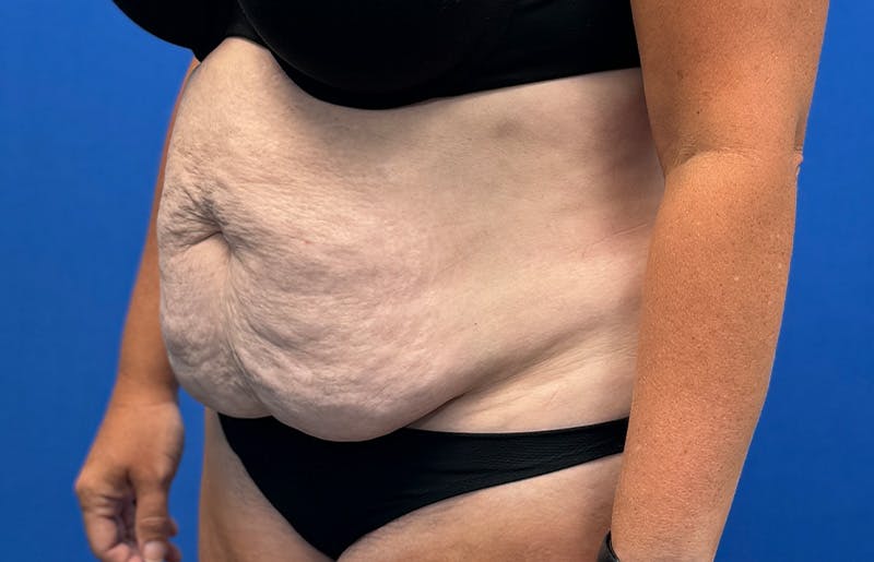 Abdominoplasty Before & After Gallery - Patient 352301 - Image 3