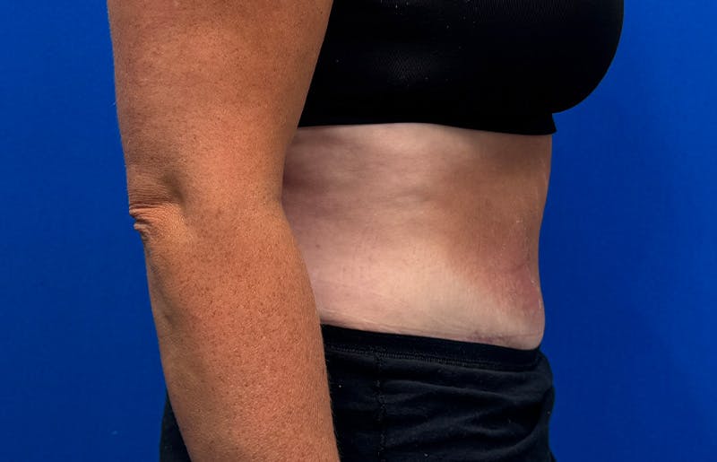 Abdominoplasty Before & After Gallery - Patient 352301 - Image 10