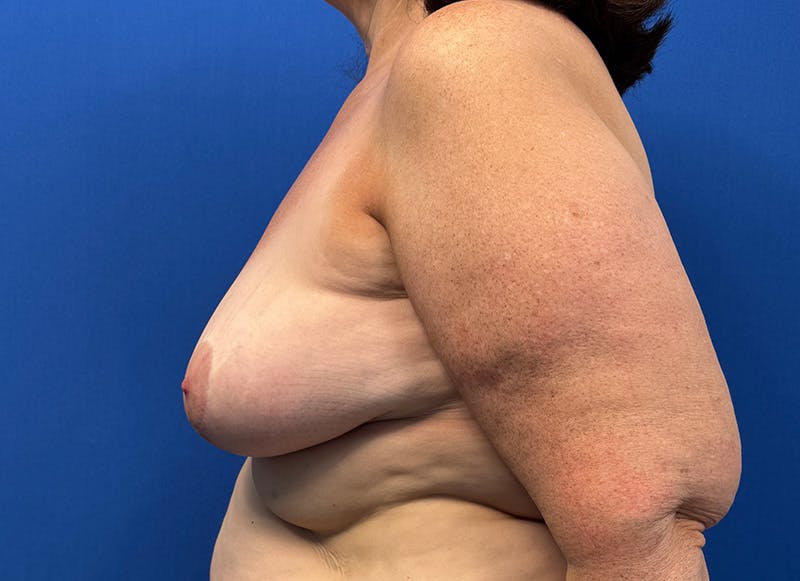 Breast Lift Before & After Gallery - Patient 415268 - Image 1