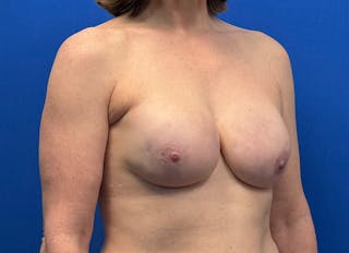 Implant Reconstruction Gallery Before & After Gallery - Patient 443329 - Image 8