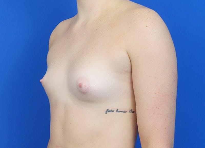 Implant Reconstruction Gallery Before & After Gallery - Patient 358081 - Image 3