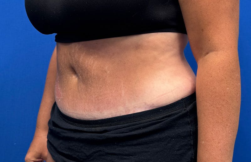 Abdominoplasty Before & After Gallery - Patient 352301 - Image 4