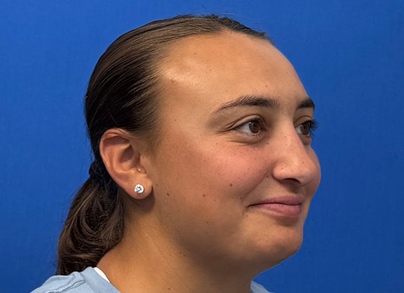 Rhinoplasty Before & After Gallery - Patient 445507 - Image 8