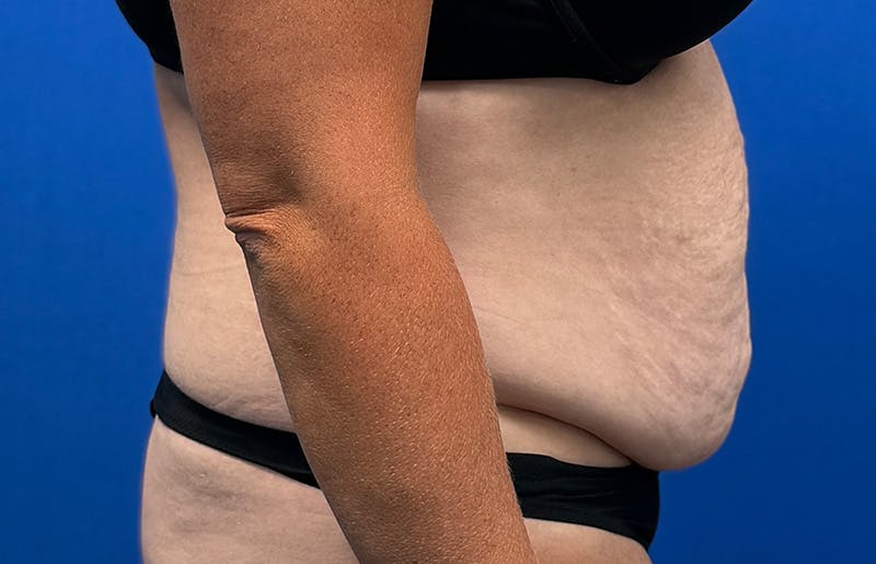 Abdominoplasty Before & After Gallery - Patient 352301 - Image 9