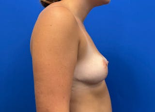 Breast Reduction Before & After Gallery - Patient 726793 - Image 10