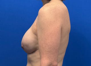 Implant Reconstruction Gallery Before & After Gallery - Patient 443329 - Image 2