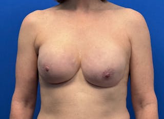 Implant Reconstruction Gallery Before & After Gallery - Patient 443329 - Image 6