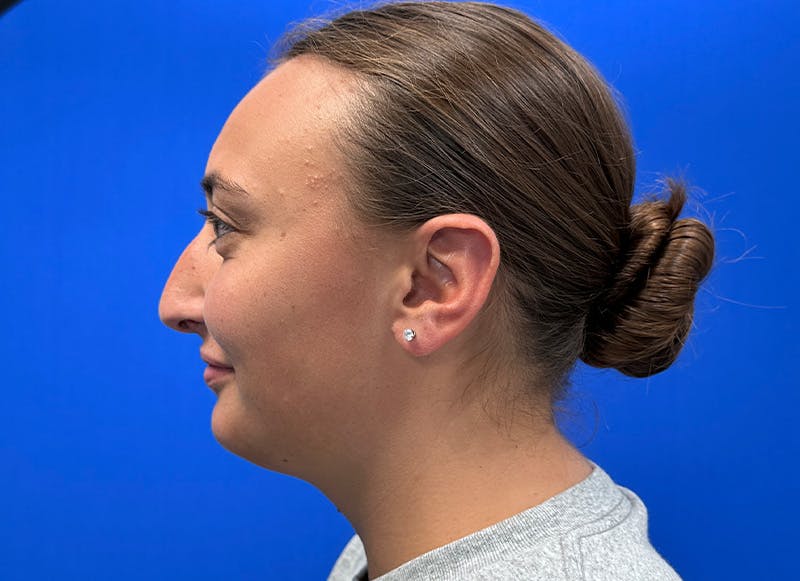 Rhinoplasty Before & After Gallery - Patient 445507 - Image 1