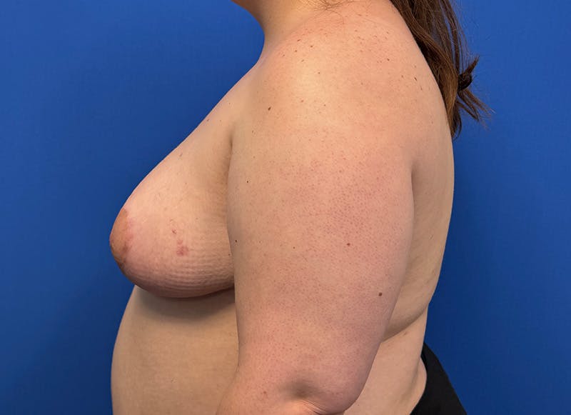 Breast Lift Before & After Gallery - Patient 981827 - Image 2
