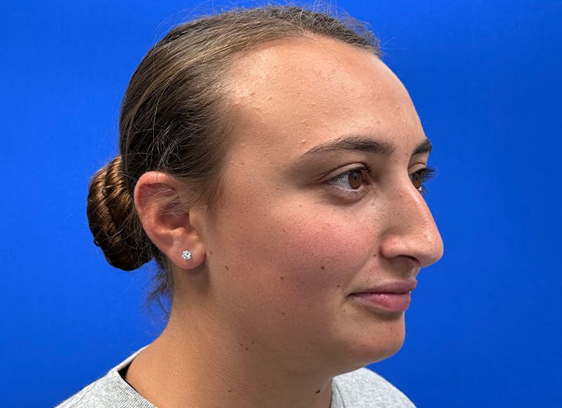 Rhinoplasty Before & After Gallery - Patient 445507 - Image 7