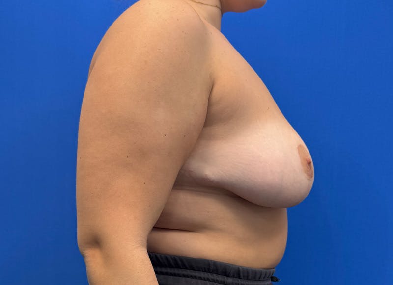 Breast Reduction Before & After Gallery - Patient 294917 - Image 10
