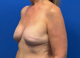 Flap Reconstruction Gallery Before & After Gallery - Patient 410362 - Image 4