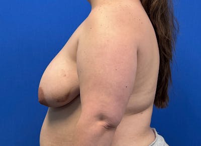 Breast Lift Before & After Gallery - Patient 981827 - Image 1