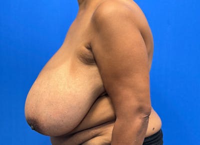Breast Reduction Before & After Gallery - Patient 396023 - Image 1