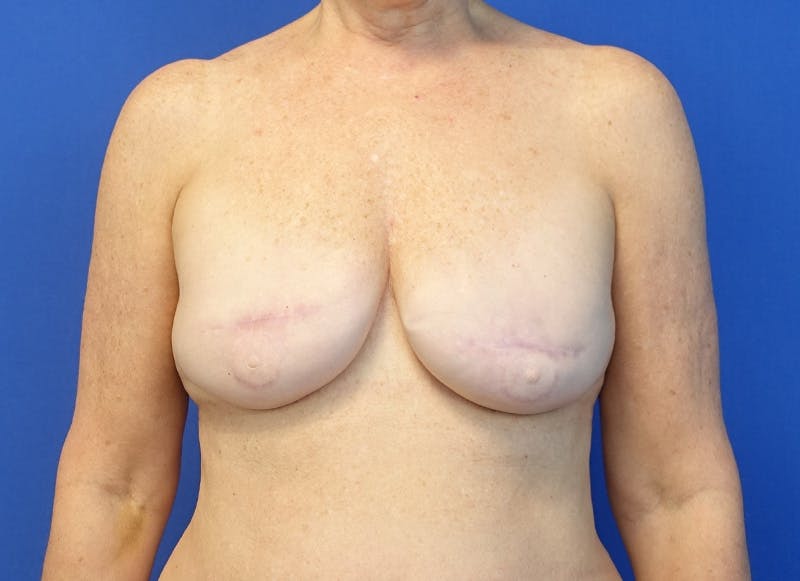 Flap Reconstruction Gallery Before & After Gallery - Patient 410362 - Image 5