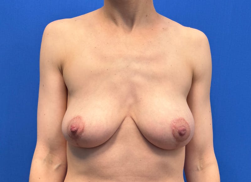 Breast Lift Before & After Gallery - Patient 546328 - Image 6