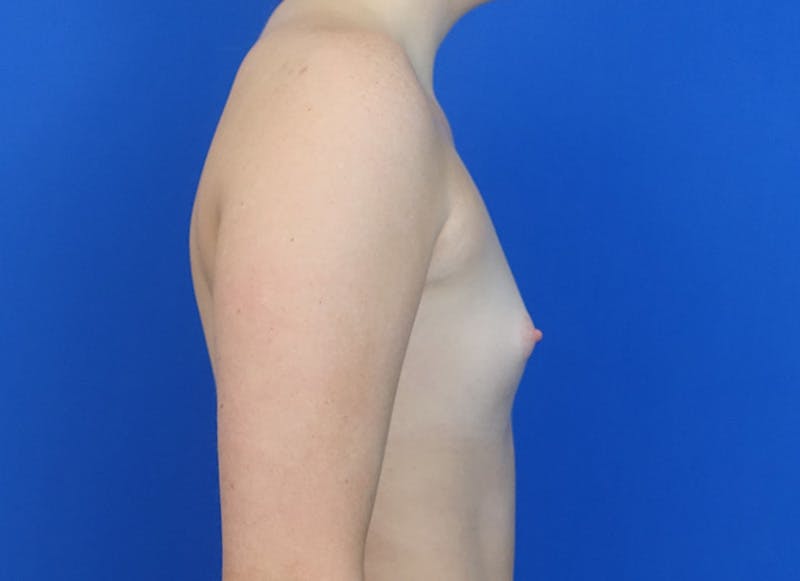 Implant Reconstruction Gallery Before & After Gallery - Patient 358081 - Image 9