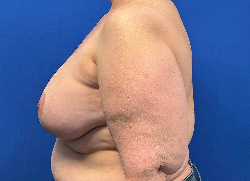 Breast Lift Before & After Gallery - Patient 415268 - Image 2