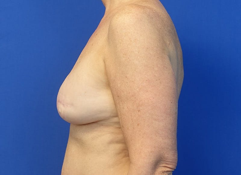 Flap Reconstruction Gallery Before & After Gallery - Patient 410362 - Image 1
