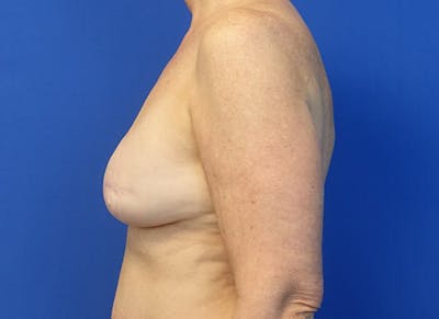 Flap Reconstruction Gallery Before & After Gallery - Patient 410362 - Image 1