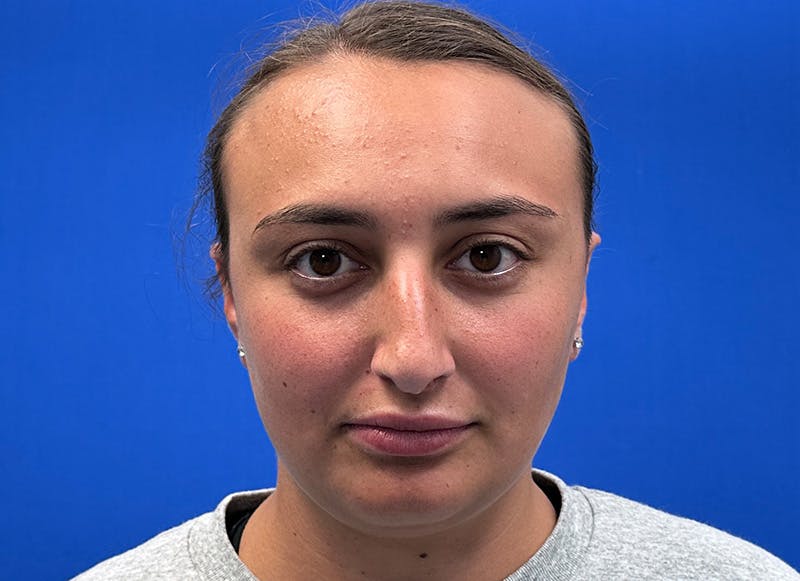 Rhinoplasty Before & After Gallery - Patient 445507 - Image 5