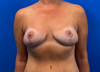 Flap Reconstruction Gallery Before & After Gallery - Patient 142927 - Image 6