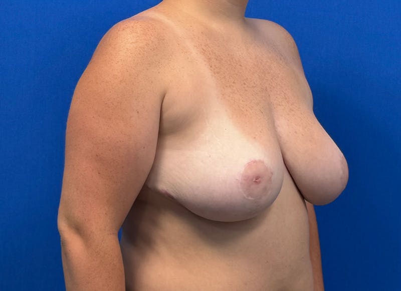 Breast Reduction Before & After Gallery - Patient 345901 - Image 8