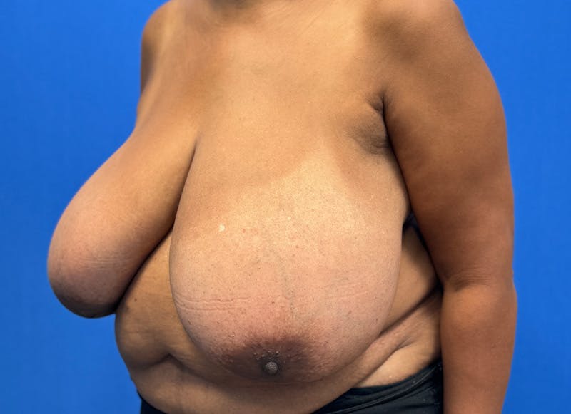 Breast Reduction Before & After Gallery - Patient 396023 - Image 3