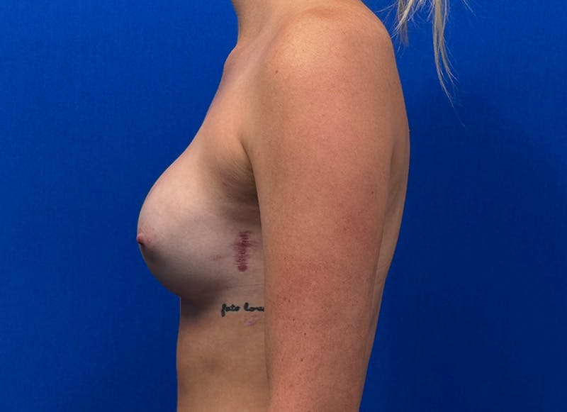 Implant Reconstruction Gallery Before & After Gallery - Patient 358081 - Image 2