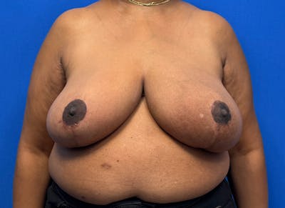 Breast Reduction Before & After Gallery - Patient 396023 - Image 6