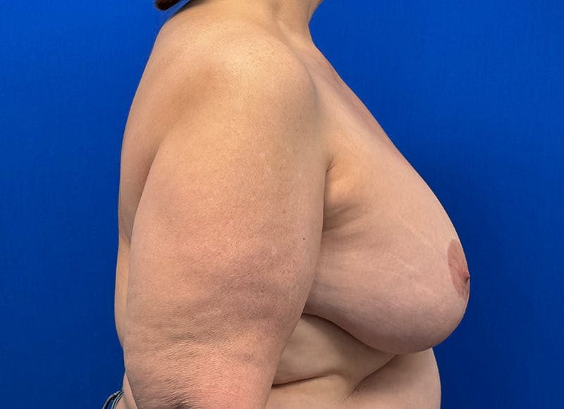 Implant Removal Before & After Gallery - Patient 350082 - Image 9