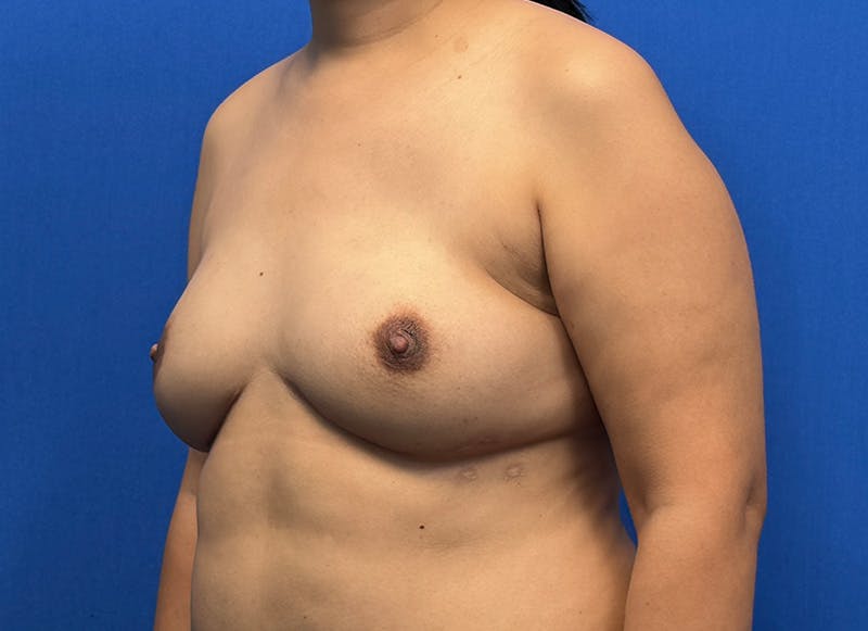 Flap Reconstruction Gallery Before & After Gallery - Patient 319108 - Image 4