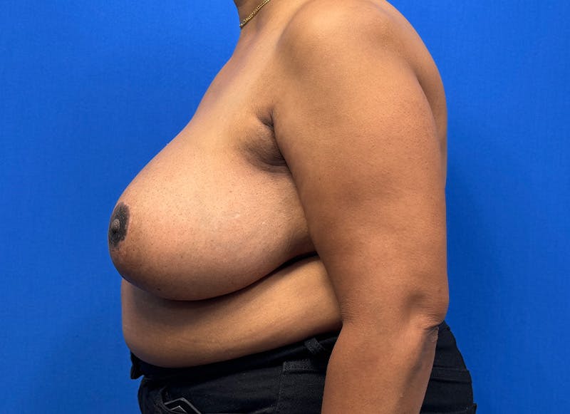 Breast Reduction Before & After Gallery - Patient 396023 - Image 2